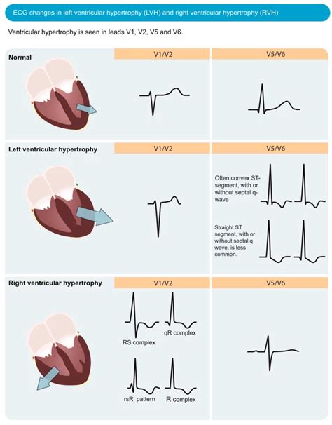 voltage criteria for left ventricular hypertrophy.